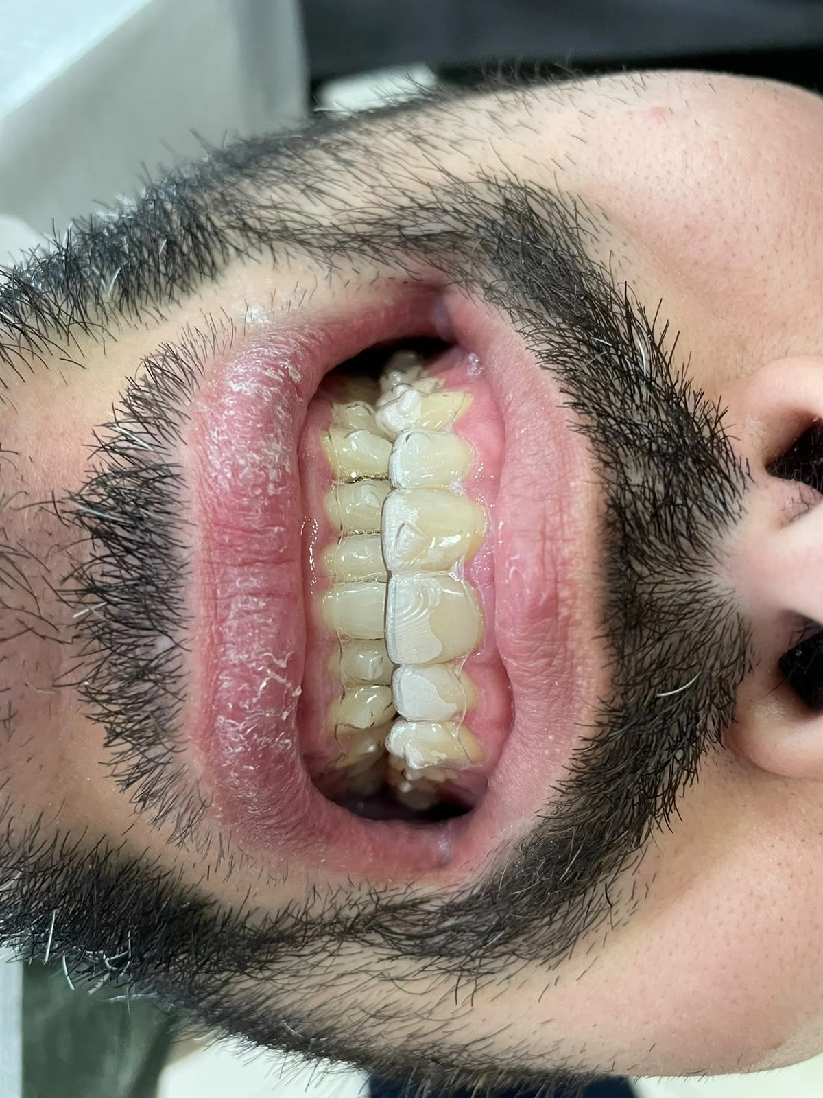 Aparelho Invisível (Alinhadores Invisíveis) — imagem fornecida